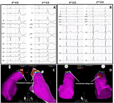 Idiopathic Premature Ventricular Contractions From the Outflow Tract Display an Underlying Substrate That Can Be Unmasked by a Type 2 Brugada Electrocardiographic Pattern at High Right Precordial Leads